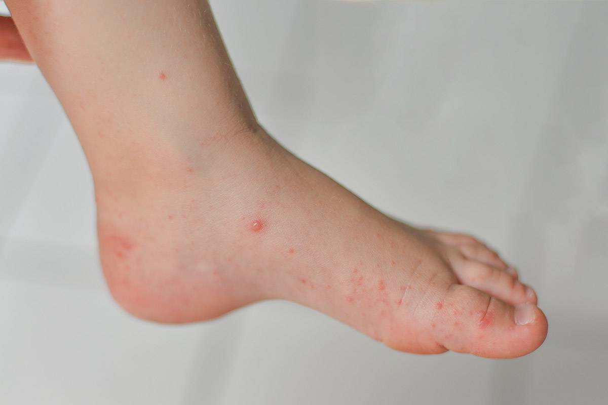 Is Hand, Foot, and Mouth Disease Contagious? What You Need to Know